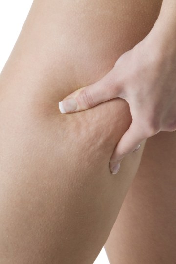 cellulite VITALIS INSTITUTE